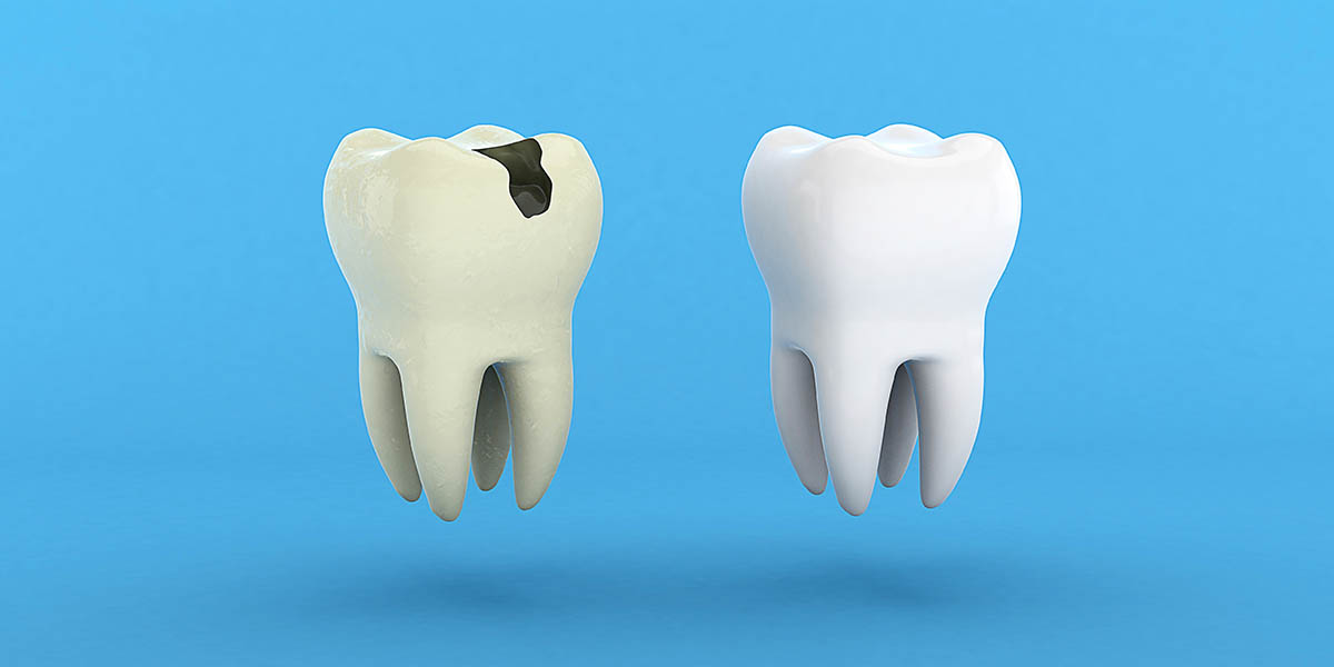 Виды перфорации зуба
