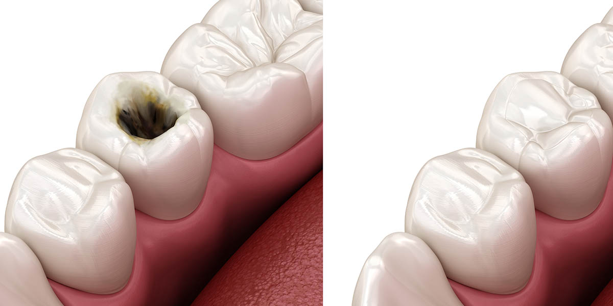 Лечение пульпита передних зубов