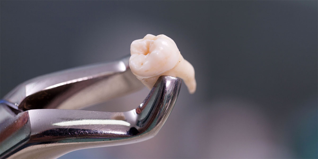 Подготовка к операции удаления зуба