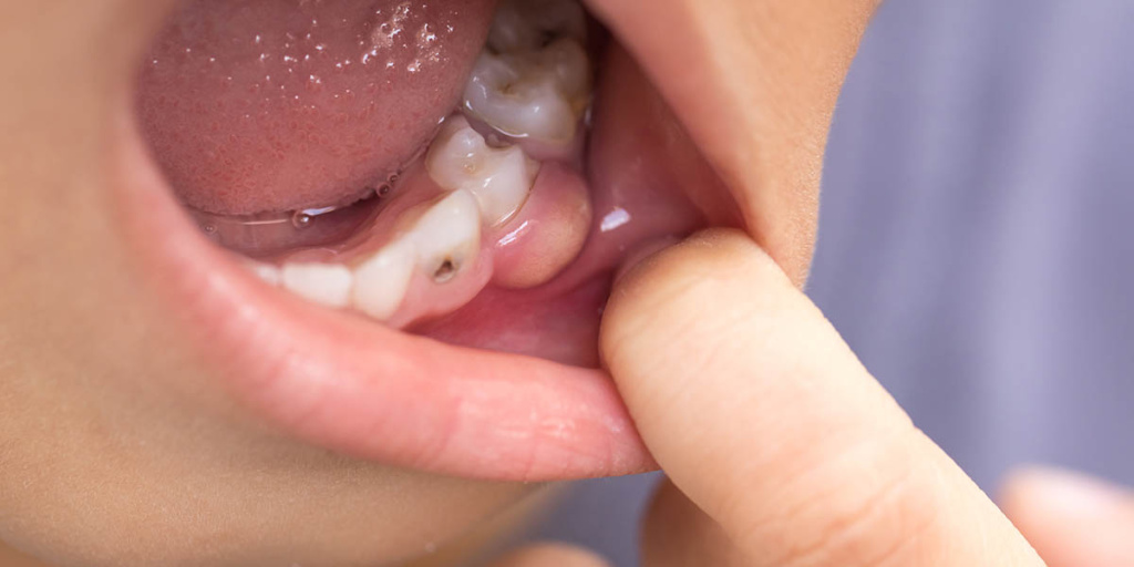 Черные молочные зубы у ребенка: причины и как лечить
