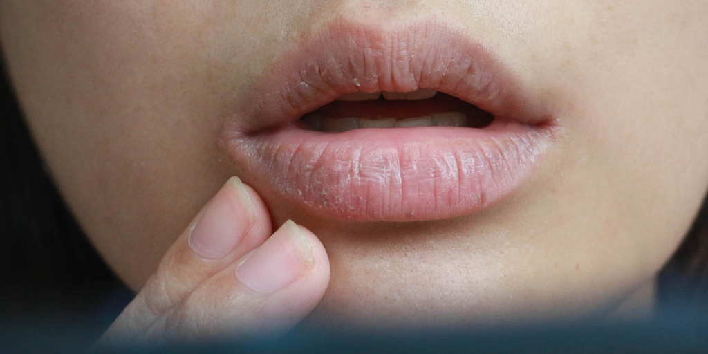 Как вылечить трещины губ