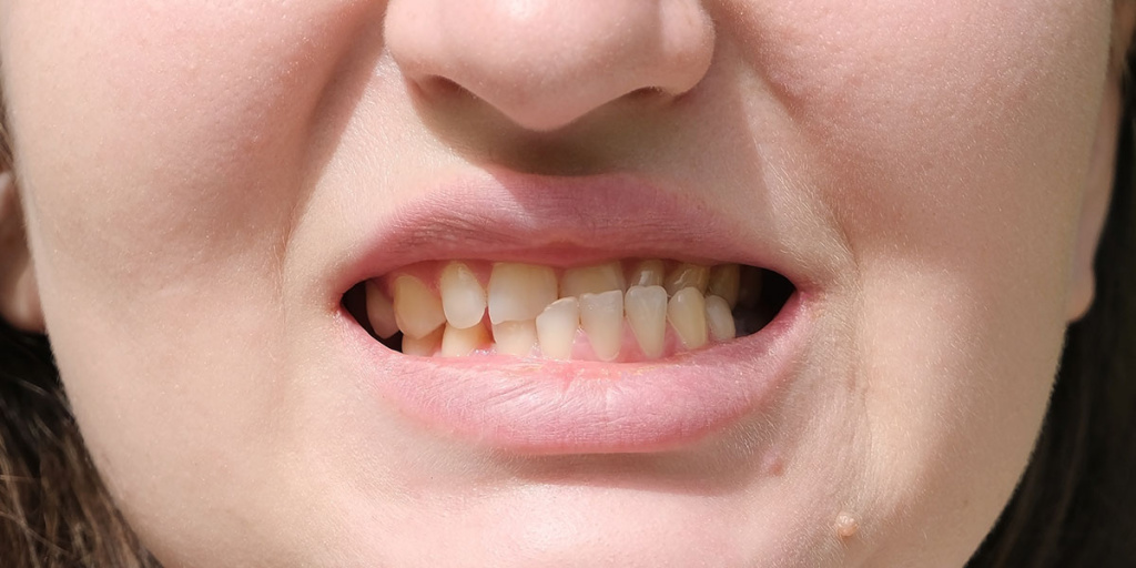 Смещение нижних зубов