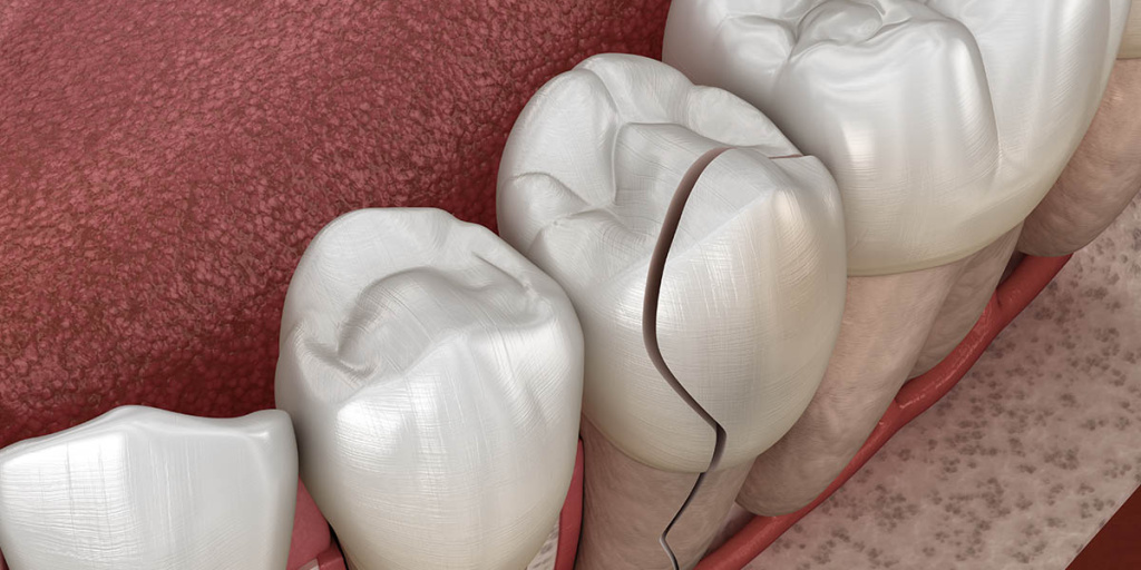 Почему крошатся зубы: причины, лечение, профилактика - Стоматология «НоваДэнт»