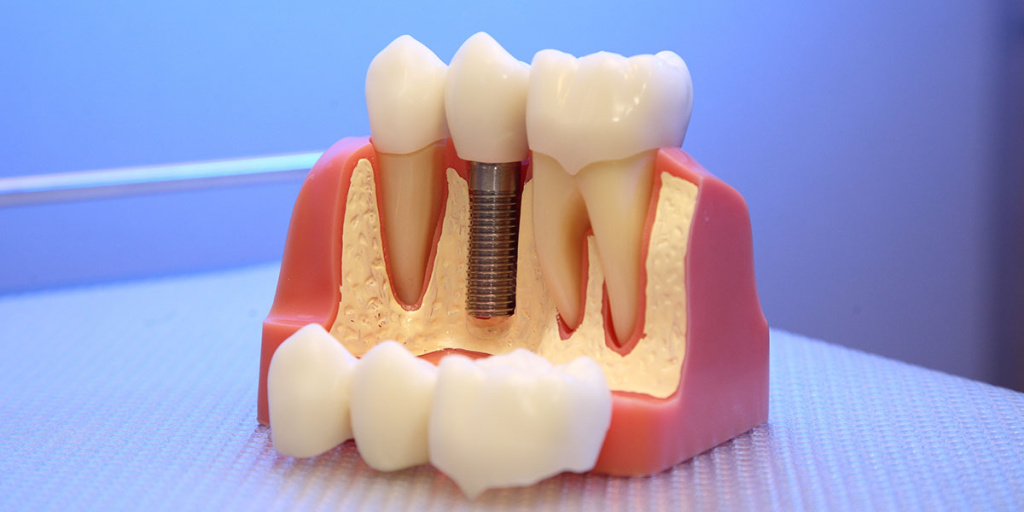 Имплантация зубов в 3D: этапы процедуры, преимущества и недостатки