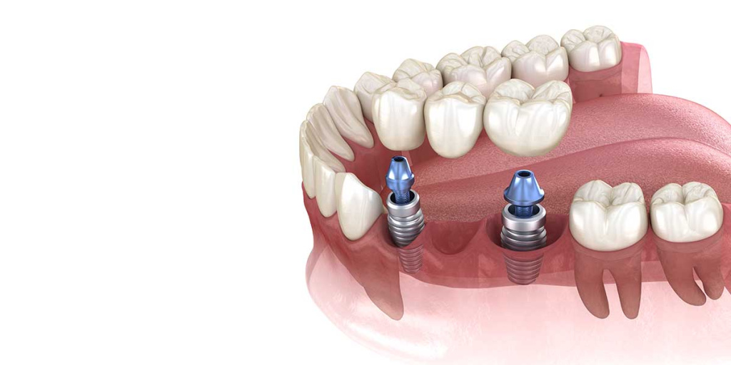 Рекомендации после имплантации | Статья DentalOpera