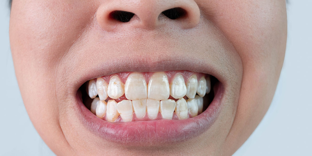 ▷ Пятна на зубах: виды и причины возникновения