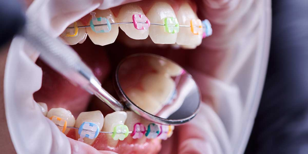 Лечение зубов с брекетами