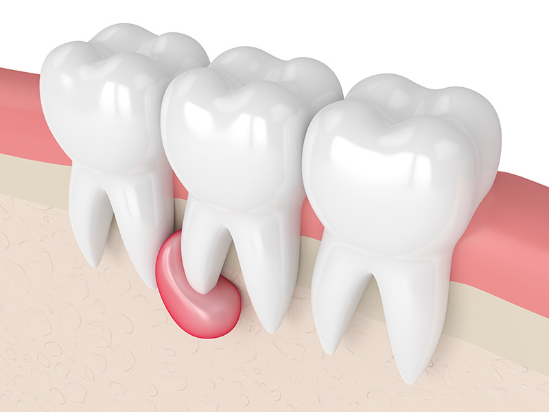Что такое киста зуба, почему она возникает и как ее вылечить без боли
