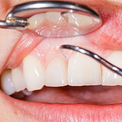 Протезирование передних зубов при пародонтозе и пародонтите: диагностика, лечение , выбор протезов