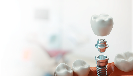 Имплантация с установкой коронки на системе Dentium «под ключ» – 89 900 руб.