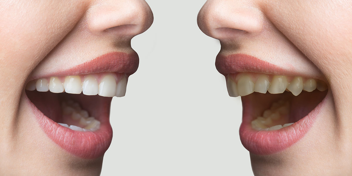 Выравнивание зубов