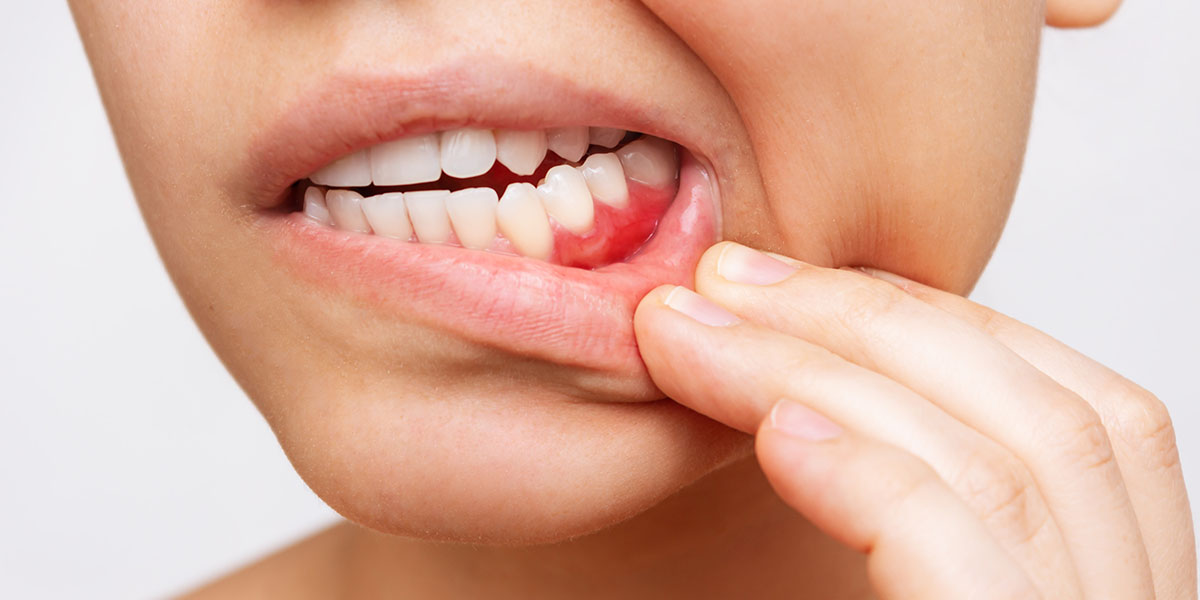 Флегмона зуба: симптомы и лечение