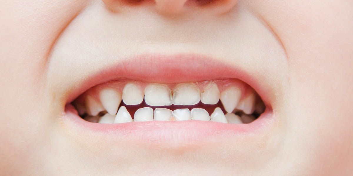 Белые пятна на зубах у ребенка: почему появляются, что делать