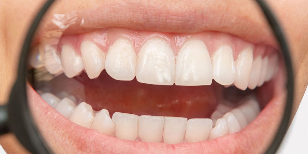 Пятна на эмали зубов